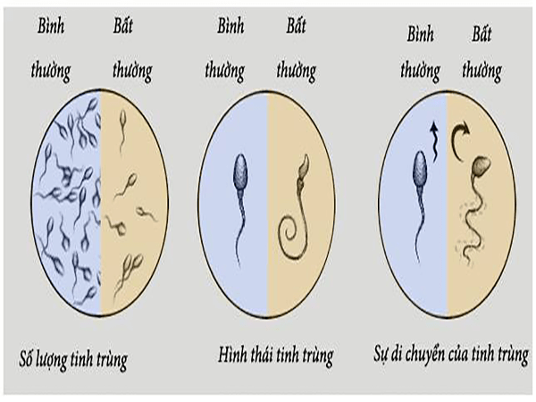 Tinh trùng yếu: Nguyên nhân, biểu hiện, cách điều trị chuẩn nhất 