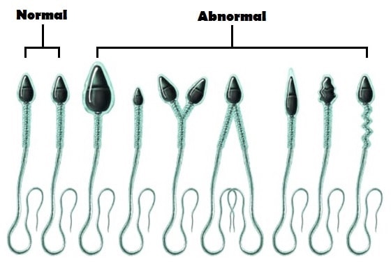 Tinh trùng dị dạng – Nỗi lo vô sinh ở nam giới  